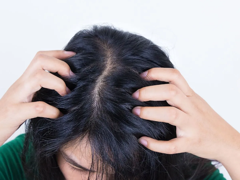 Masalah Rambut Lepek Tuntas Dengan Dove Micellar Shampoo
